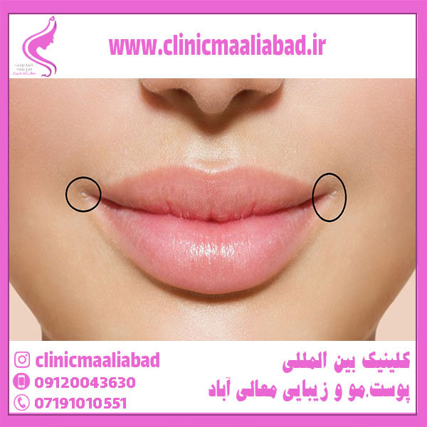 لیفت گوشه لب - بهترین کلینیک پوست و مو زیبایی شیراز