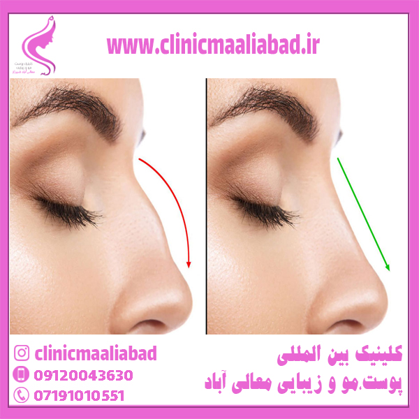 فیلم لیفت بینی با نخ - بهترین کلینیک پوست و مو زیبایی شیراز